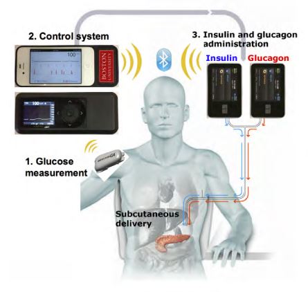 A Small Step Towards An Artificial Pancreas - Albert Fuchs, MD FACP